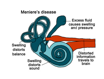 Meniere’s Disease: It’s more than just vertigo – My Neurologist